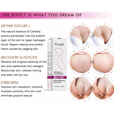 Image of Mango Stretch Mark Cream For Pregnancy Repair