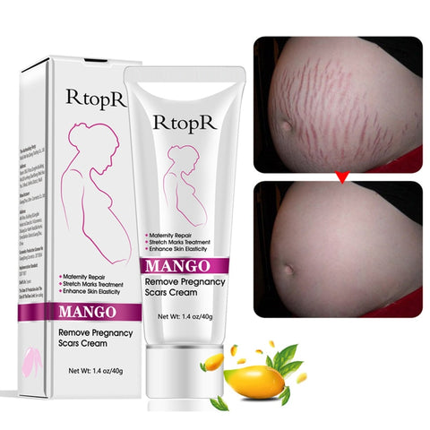 Image of Mango Stretch Mark Cream For Pregnancy Repair
