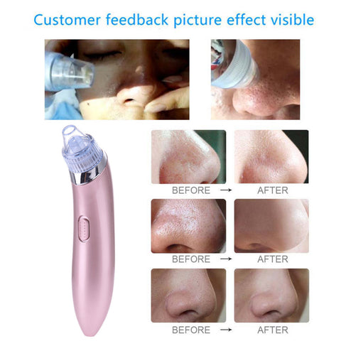 Image of Comedone Vacuum Pro