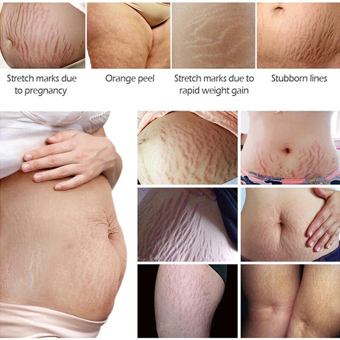 Image of VIBRANT GLAMOUR Crocodile Stretch Marks Remover Cream