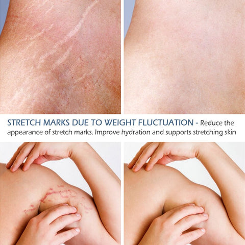 Image of VIBRANT GLAMOUR Crocodile Stretch Marks Remover Cream