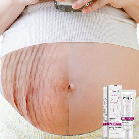 Image of Mango Stretch Mark Cream For Pregnancy Repair